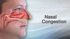 Nasal Obstruction Treatment | The Wright ENT , Plantation