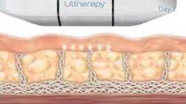 Ultherapy / 5 amazing non-surgical skin benefits, Novena