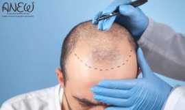 Best Hair Transplant in Bangalore - Anew Cosmetic , Bengaluru