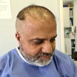 Affordable Hair Restoration Solutions, London