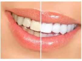 Root Canal and Crown, $ 100