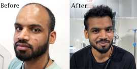 Top Clinics for Hair Transplants in South Delhi , New Delhi