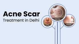 Acne Scar Treatment In Delhi - Mehektagul, New Delhi