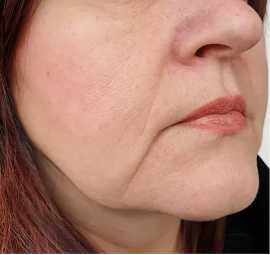 Rejuvenate Skin with Skin Tightening Treatment, Ottawa