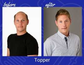 Spotting Hair Loss at the Back of Your Head, Chicago