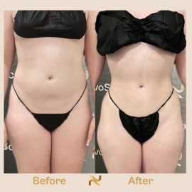 Hip Contouring Surgery, Cos Cob
