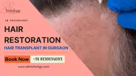 Choose Wisely Before Your Hair Restoration Journey, Faridabad