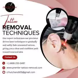 Best Tattoo Removal Techniques, McKinney