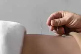 Unlock Natural Healing with Expert Acupuncture, Dublin