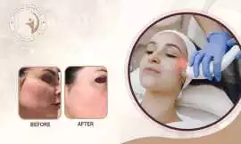 Leading Laser Treatment Centre – Aafiyataesthetics, Mississauga