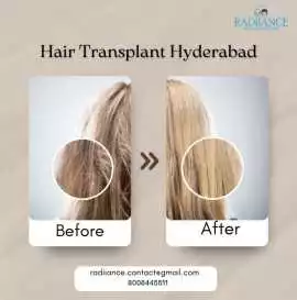 Permanent Hair Restoration in Hyderabad | Book You, Hyderabad