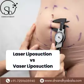 Advanced Fat Removal: Laser Liposuction vs Vaser, Bengaluru