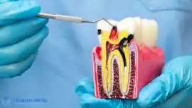 Gentle Laser Root Canals for Faster, Dental Relief, Denver