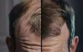 Best Solution for Thinning Hair with Personalized , Chicago