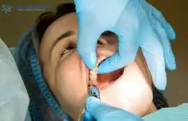 Wisdom Teeth Removal & Tooth Extraction Denver, Denver