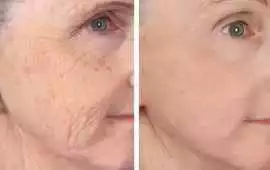 Fractionated CO2 Laser for Acne Scars &.., Altamonte Springs